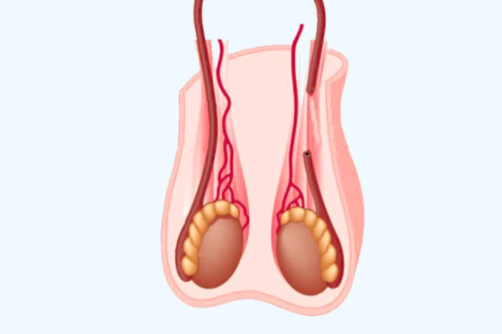 Vasectomy in New Zealand: Recovery Time, Risks, and What to Expect