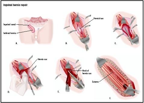 Hernia Repair Auckland: Understanding Costs, Procedures, and Care